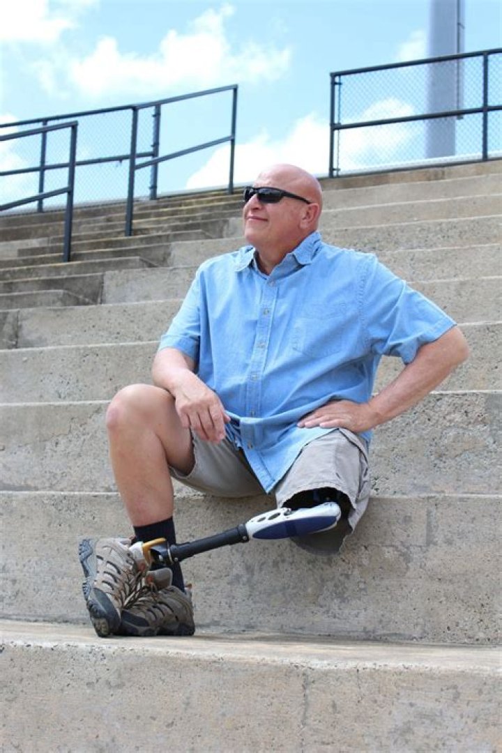 Resilience, Triumph, And Life After Leg Amputation